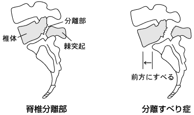 脊椎分離症