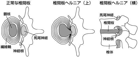 椎間板ヘルニア